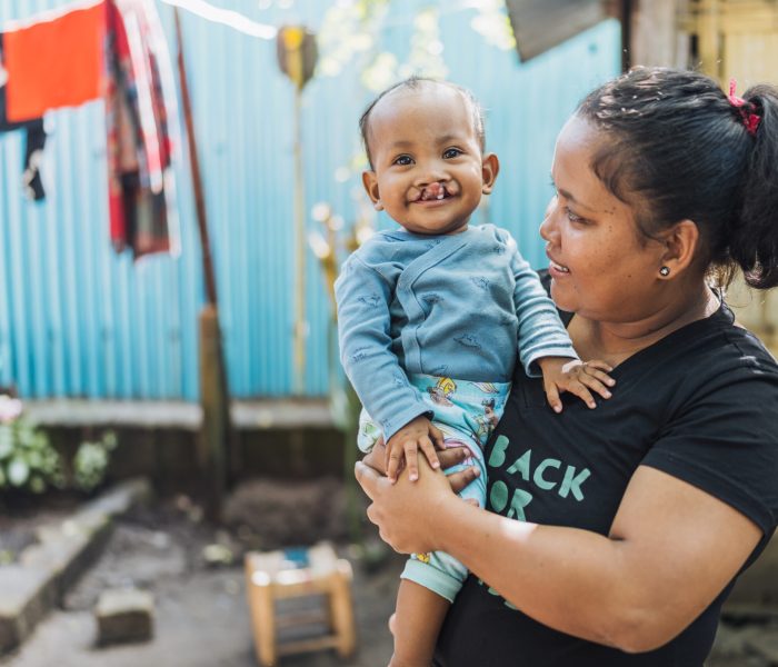 Anjara, 10-month-old bilateral cleft lip patient, at home in Toamasina with her mother, Lalaina.