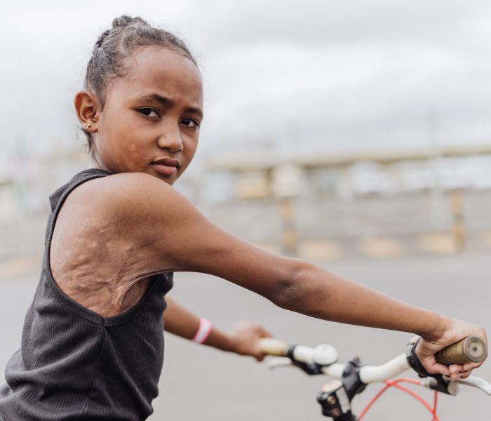 Annica, plastics patient.