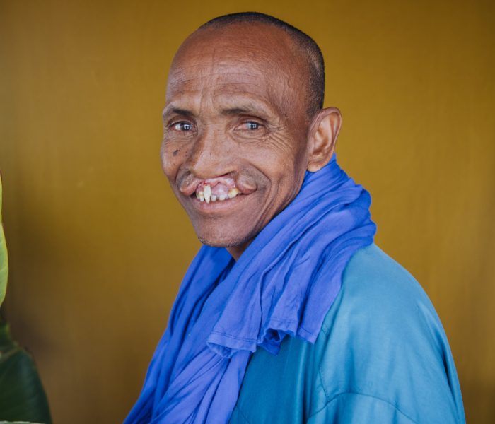 Samba, cleft lip patient, before surgery.