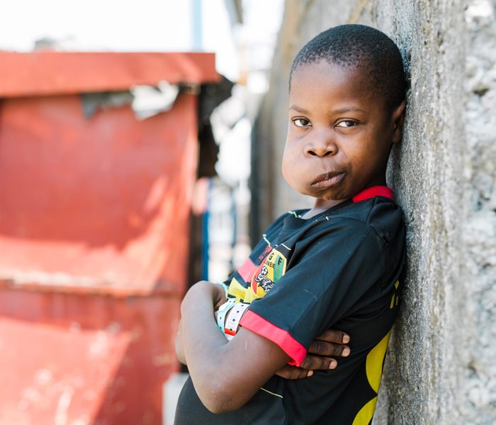 Sekouba, maxillofacial patient, before his surgery.